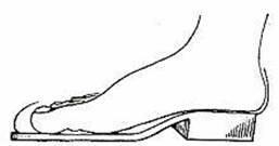 Положення стопи, що викликає дискомфорт - лінія перегину стопи не збігається з лінією згину взуття, поздовжній звід стопи провисає